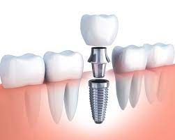 Restorative Dental implants Restorative Dental implants