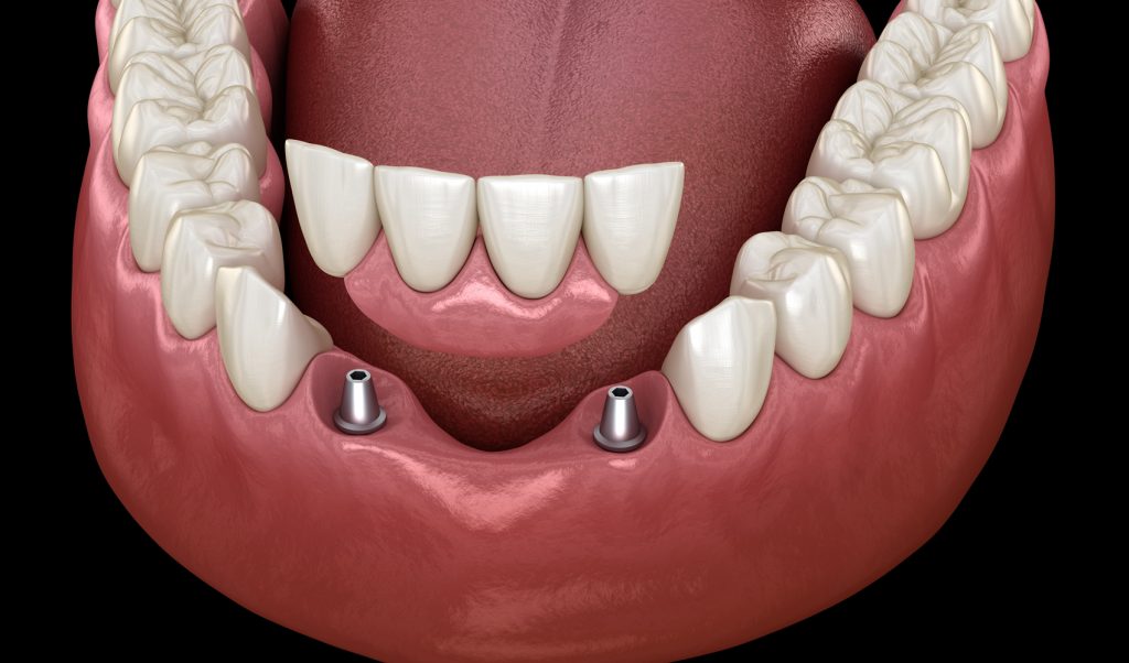 Partial dentures Partial dentures